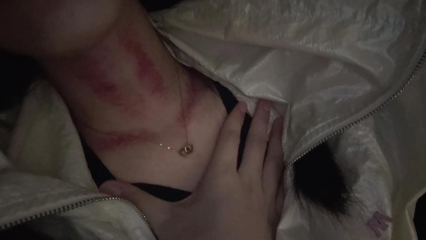 脖子被扎多根烧烤签,被烧烤签子扎出血了